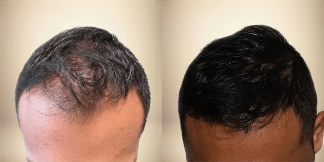 before-and-after-hair-restoration