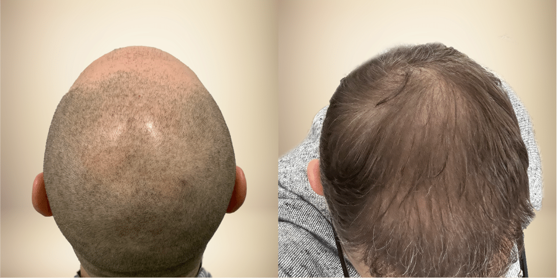 before-and-after-hair-restoration