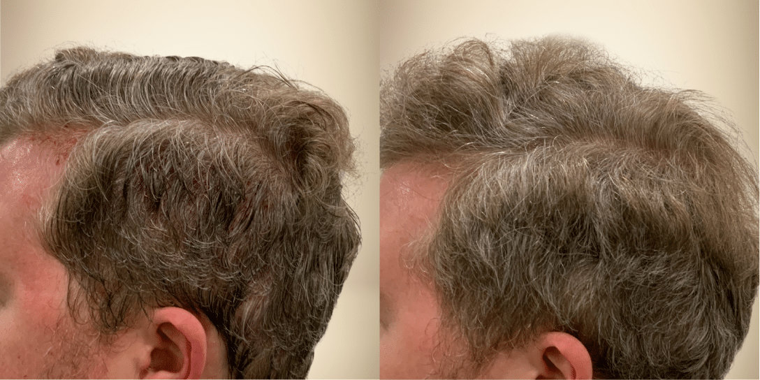 before-and-after-hair-restoration