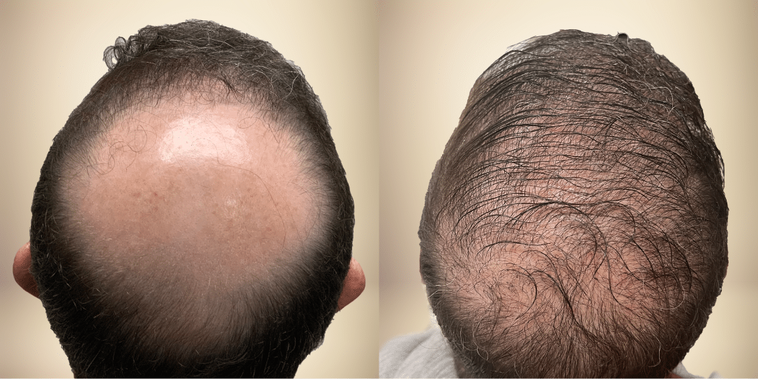 before-and-after-hair-restoration