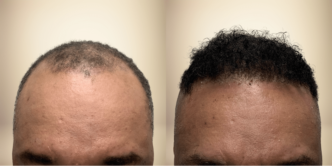 before-and-after-hair-restoration