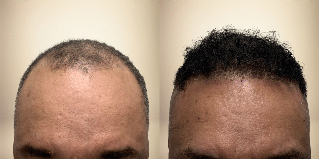 before-and-after-hair-restoration