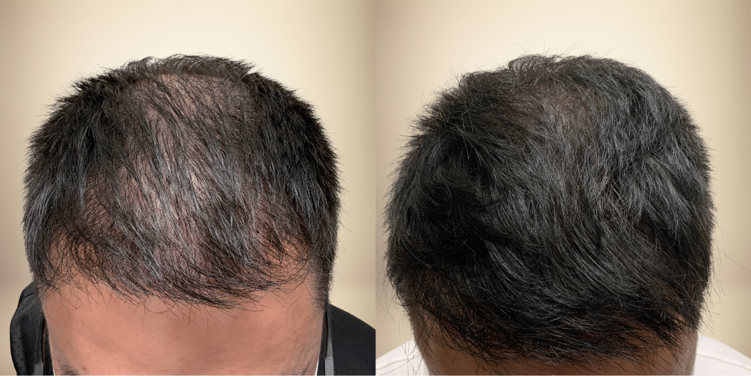 before-and-after-hair-restoration