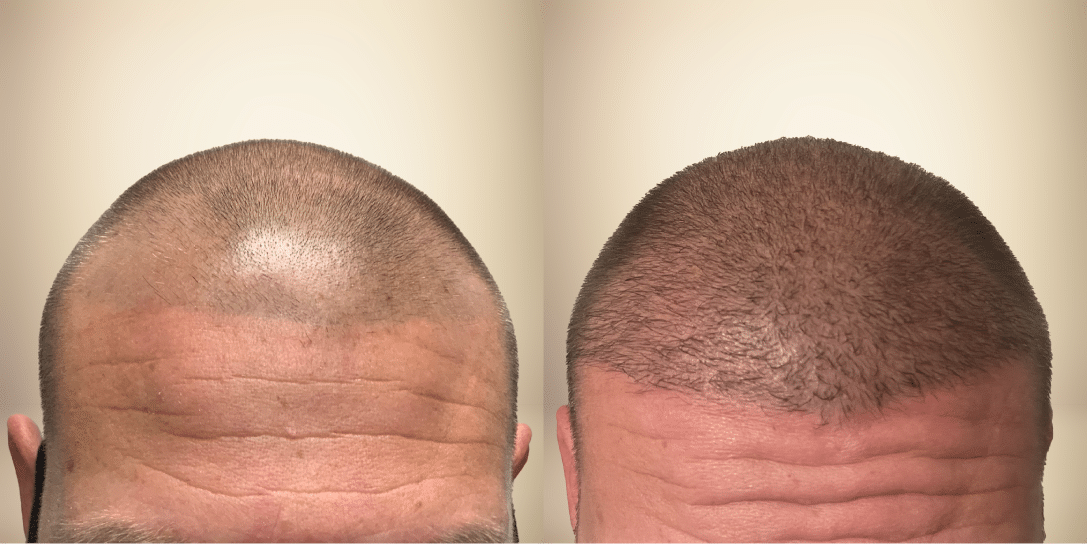Before-After 03 before-and-after-hair-restoration