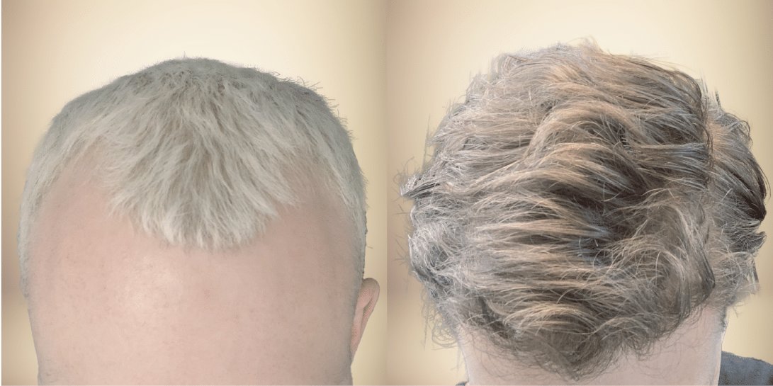 before-and-after-hair-restoration