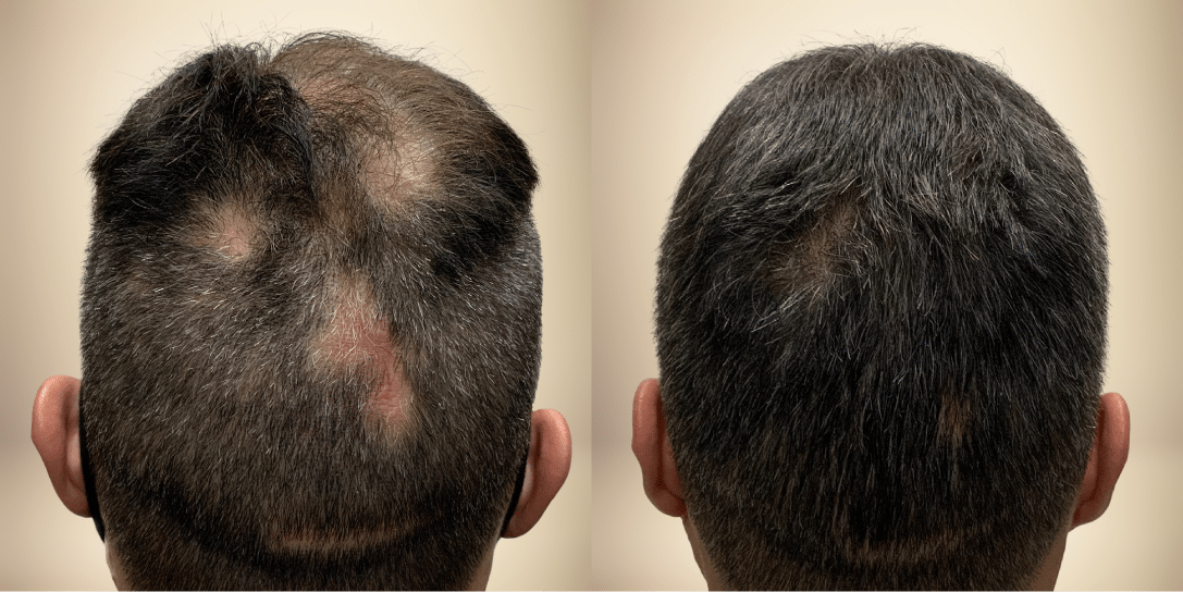 before-and-after-hair-restoration