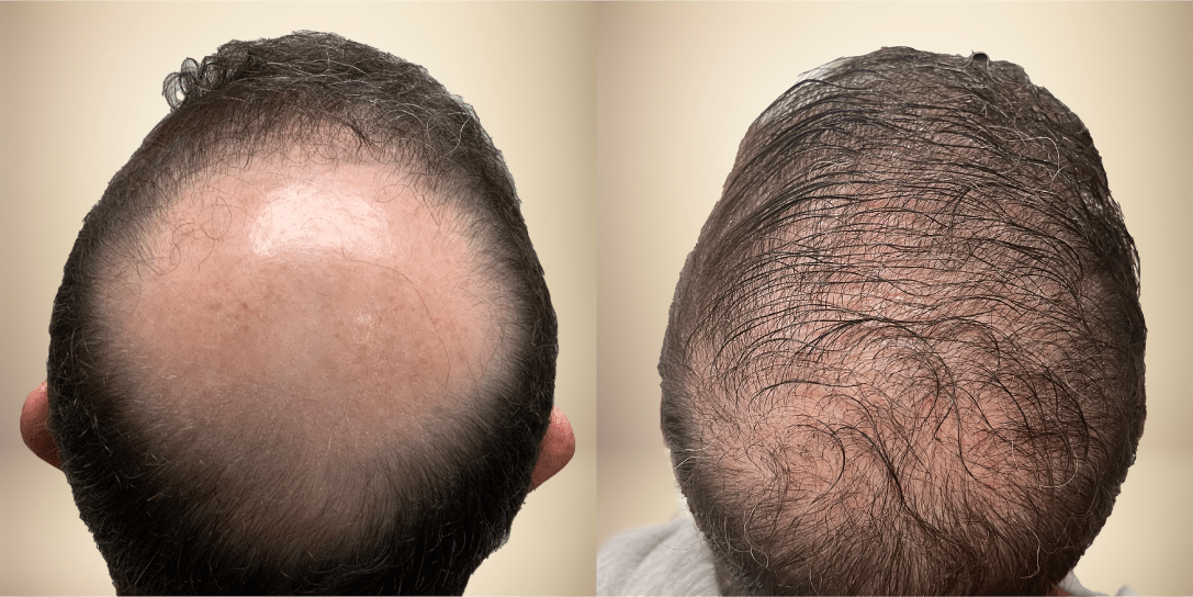 before-and-after-hair-restoration