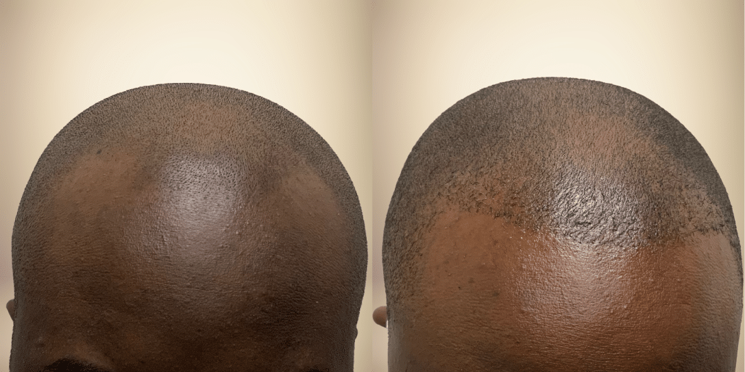 before-and-after-hair-restoration