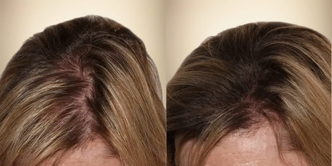 Before-After 04 before-and-after-hair-restoration