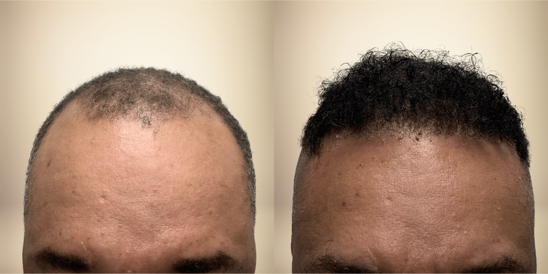 before-and-after-hair-restoration