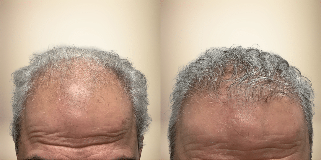 before-and-after-hair-restoration