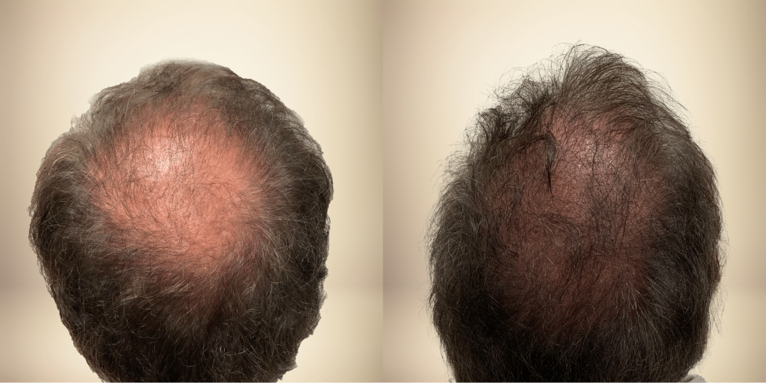 before-and-after-hair-restoration