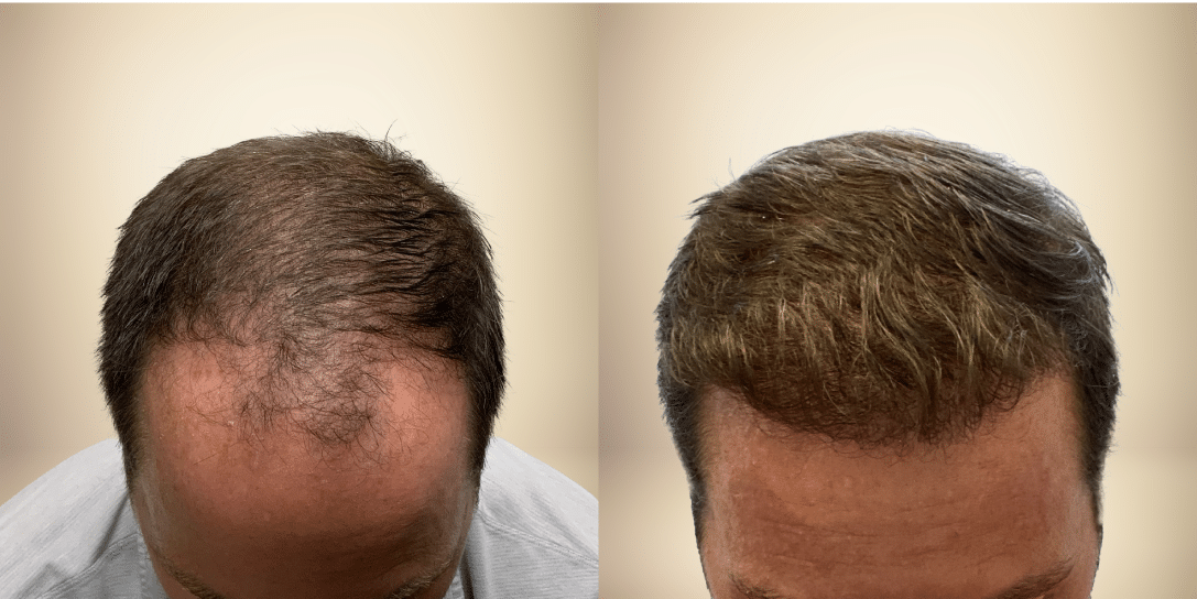 before-and-after-hair-restoration