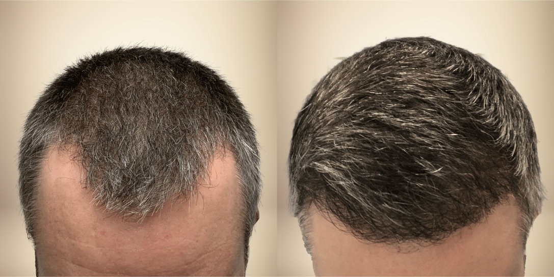 before-and-after-hair-restoration