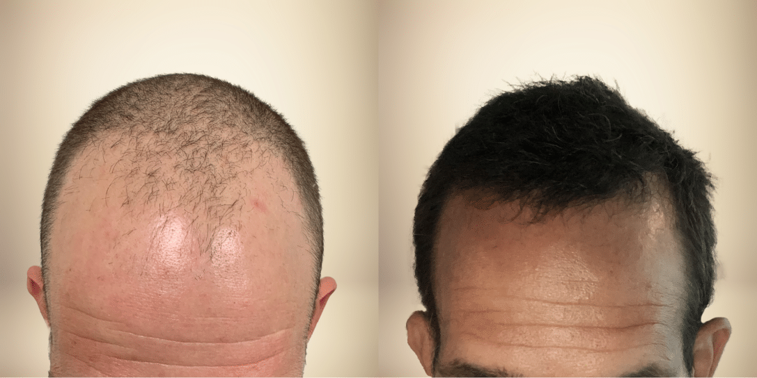 before-and-after-hair-restoration