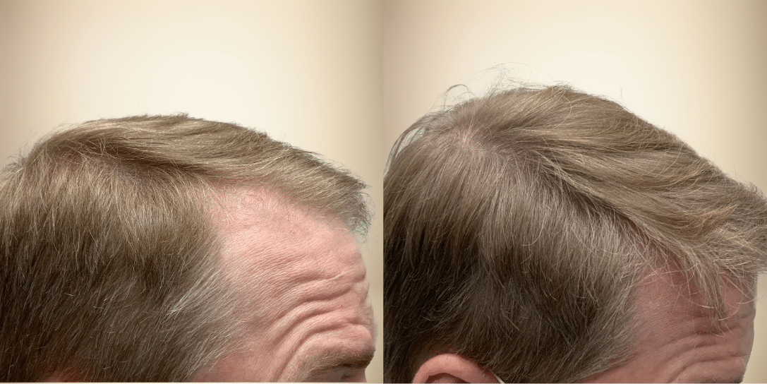 before-and-after-hair-restoration