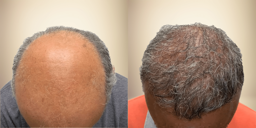 before-and-after-hair-restoration