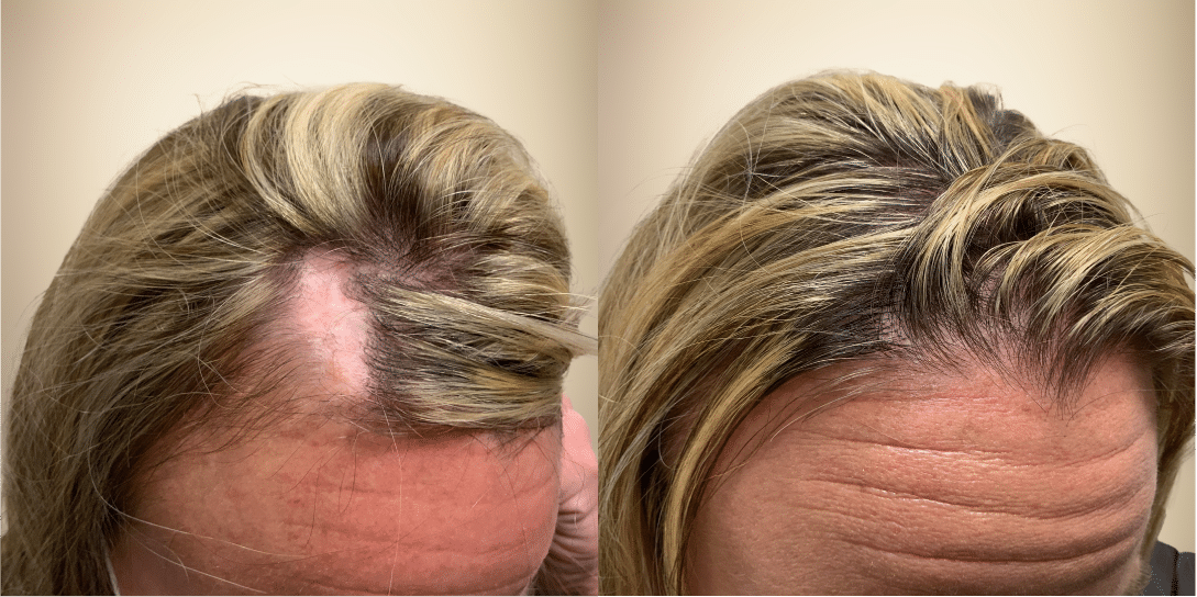 before-and-after-hair-restoration