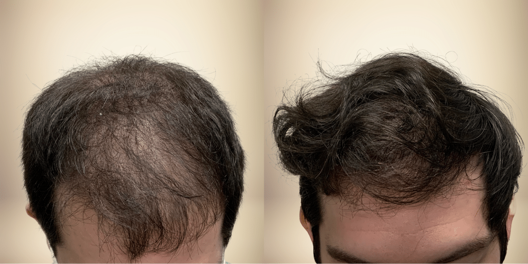before-and-after-hair-restoration