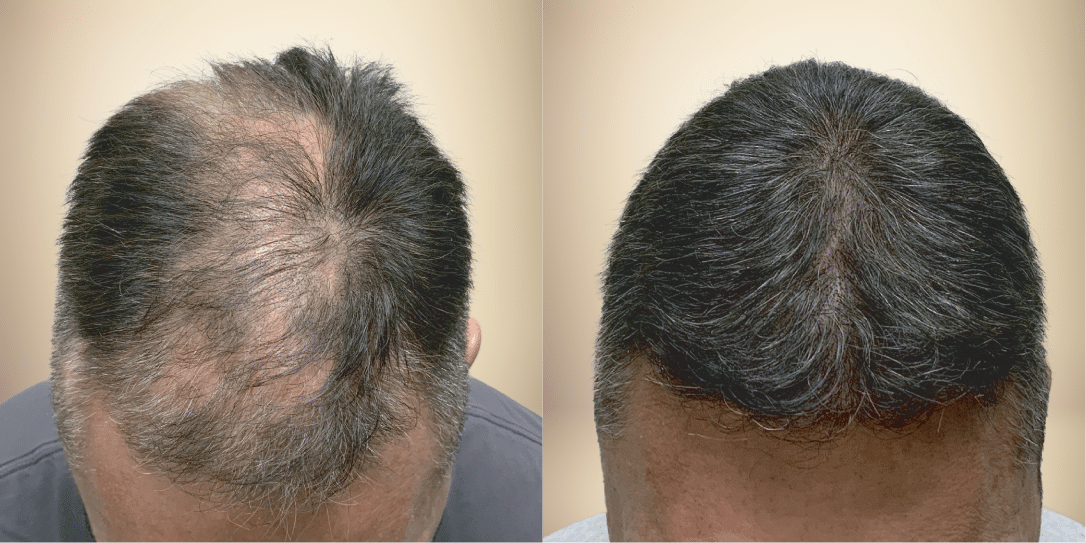 before-and-after-hair-restoration