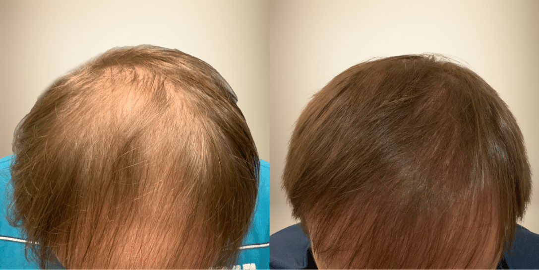 before-and-after-hair-restoration