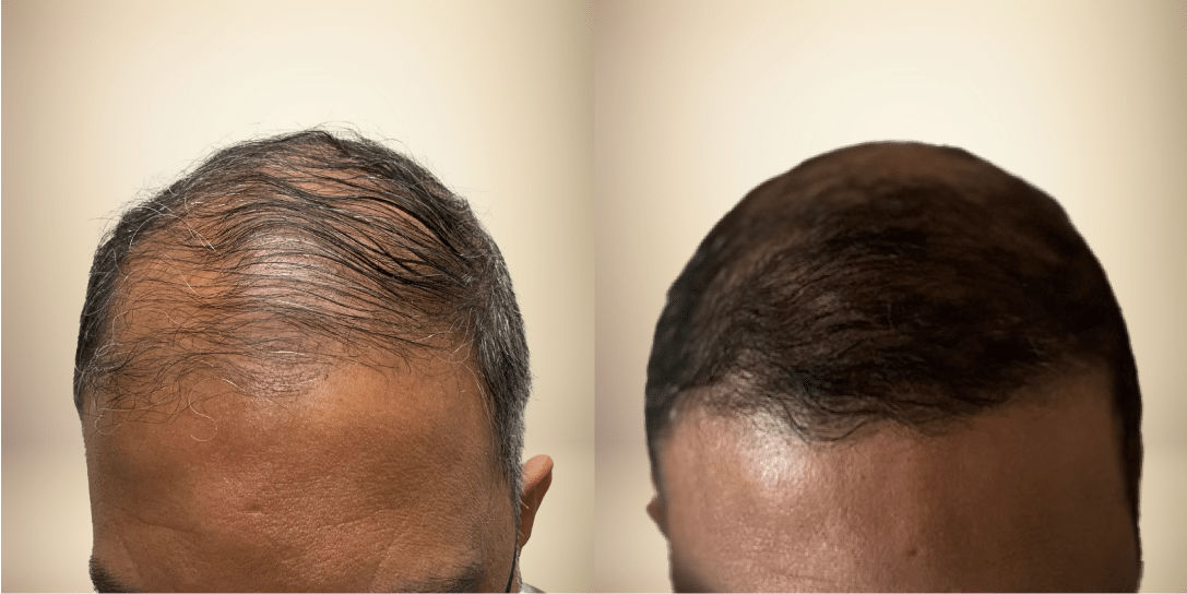 before-and-after-hair-restoration