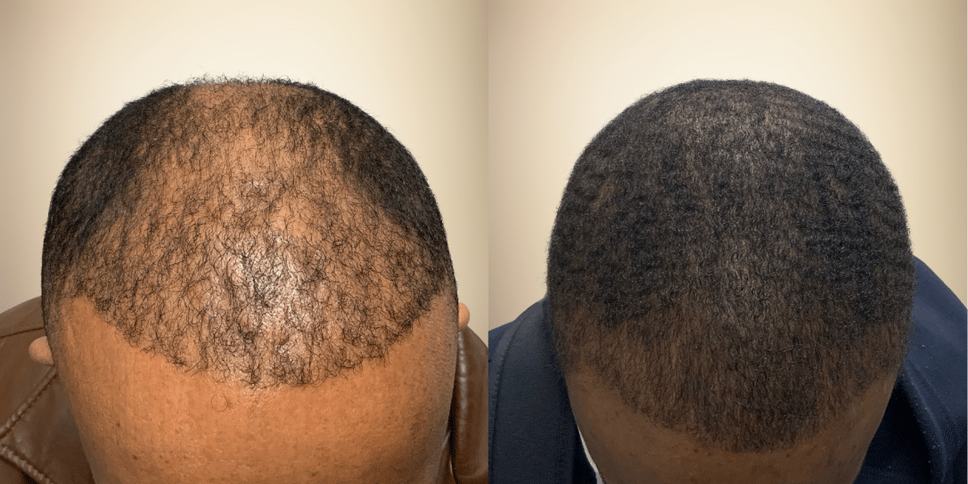 before-and-after-hair-restoration