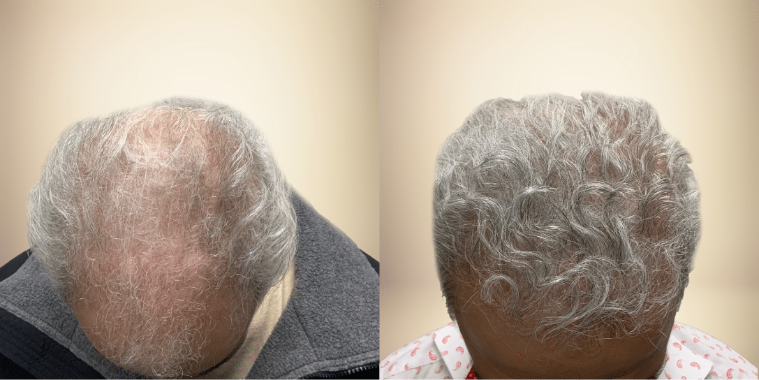 before-and-after-hair-restoration
