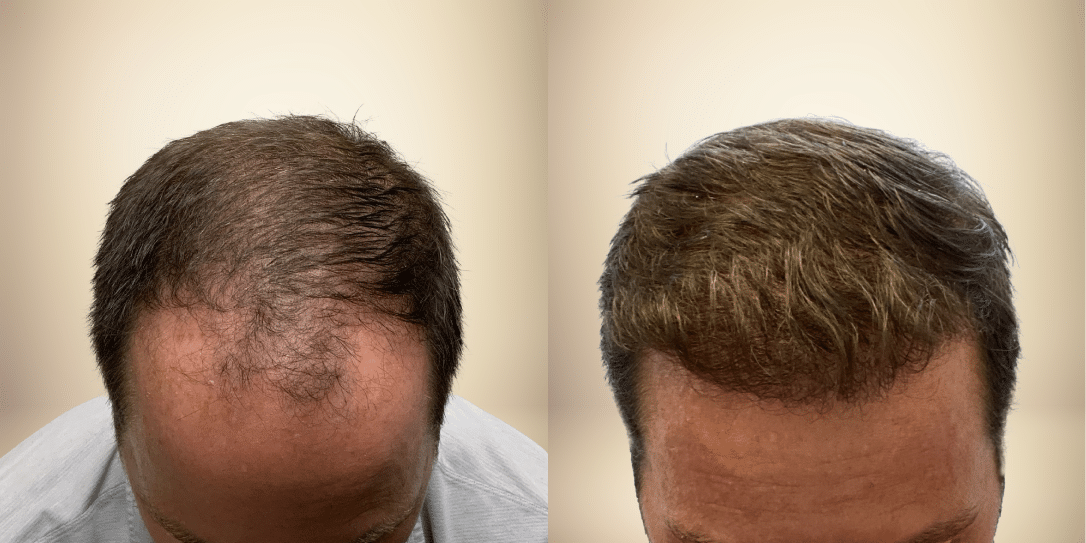 Before-And-After-04 before-and-after-hair-restoration
