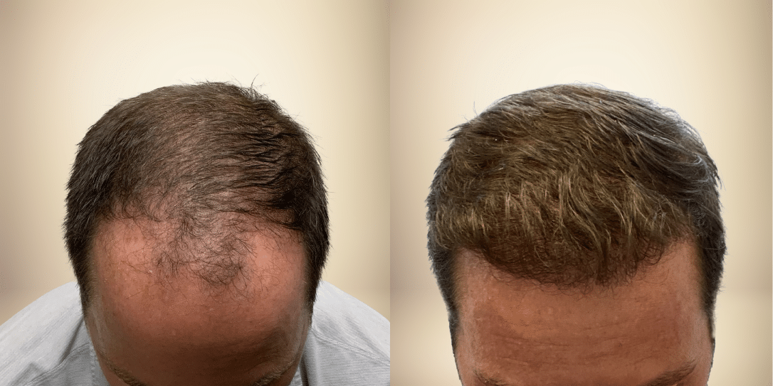 before-and-after-hair-restoration