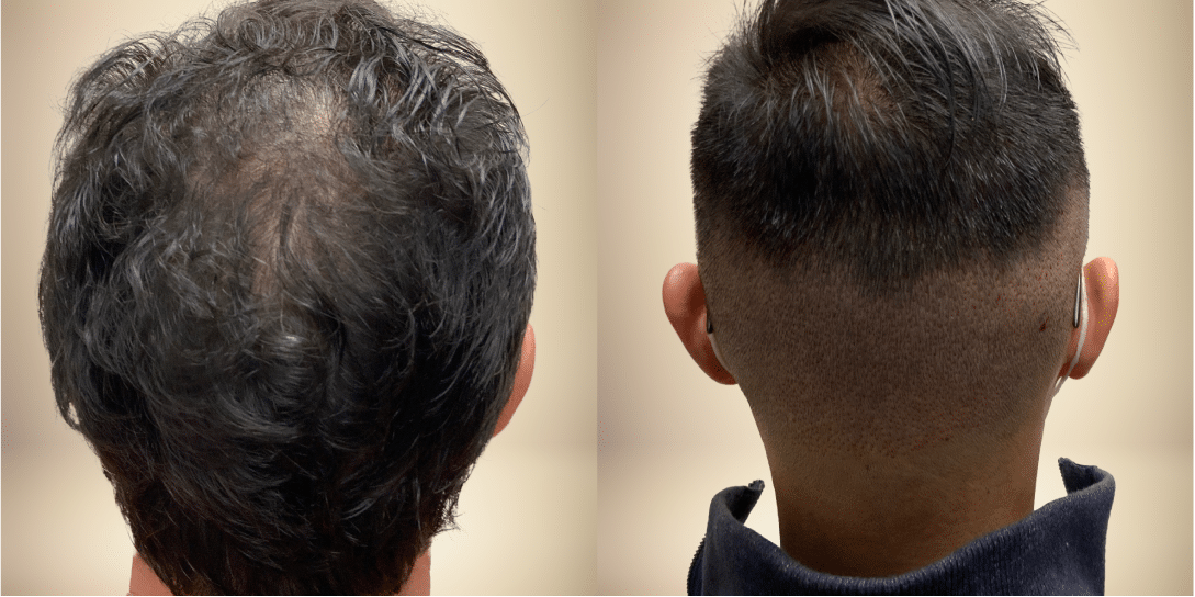 before-and-after-hair-restoration