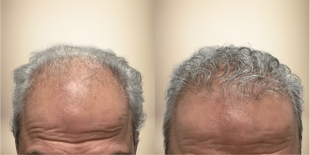 before-and-after-hair-restoration