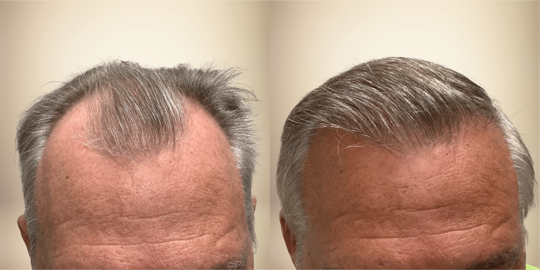 before-and-after-hair-restoration