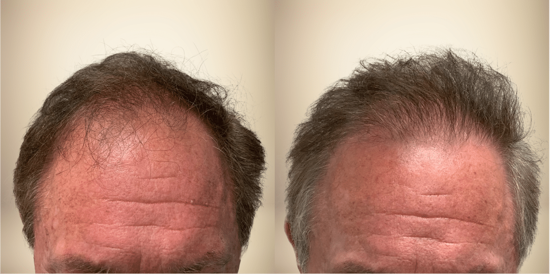 Before-And-After 08 before-and-after-hair-restoration