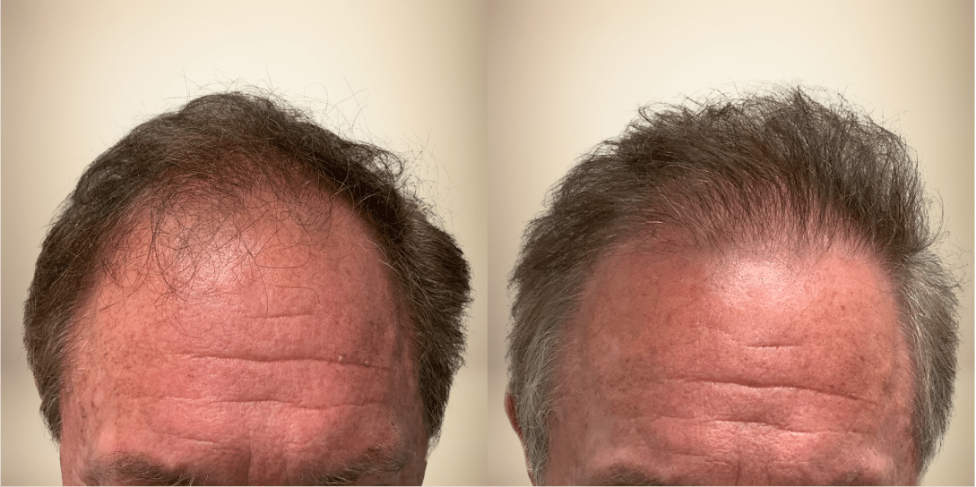 before-and-after-hair-restoration