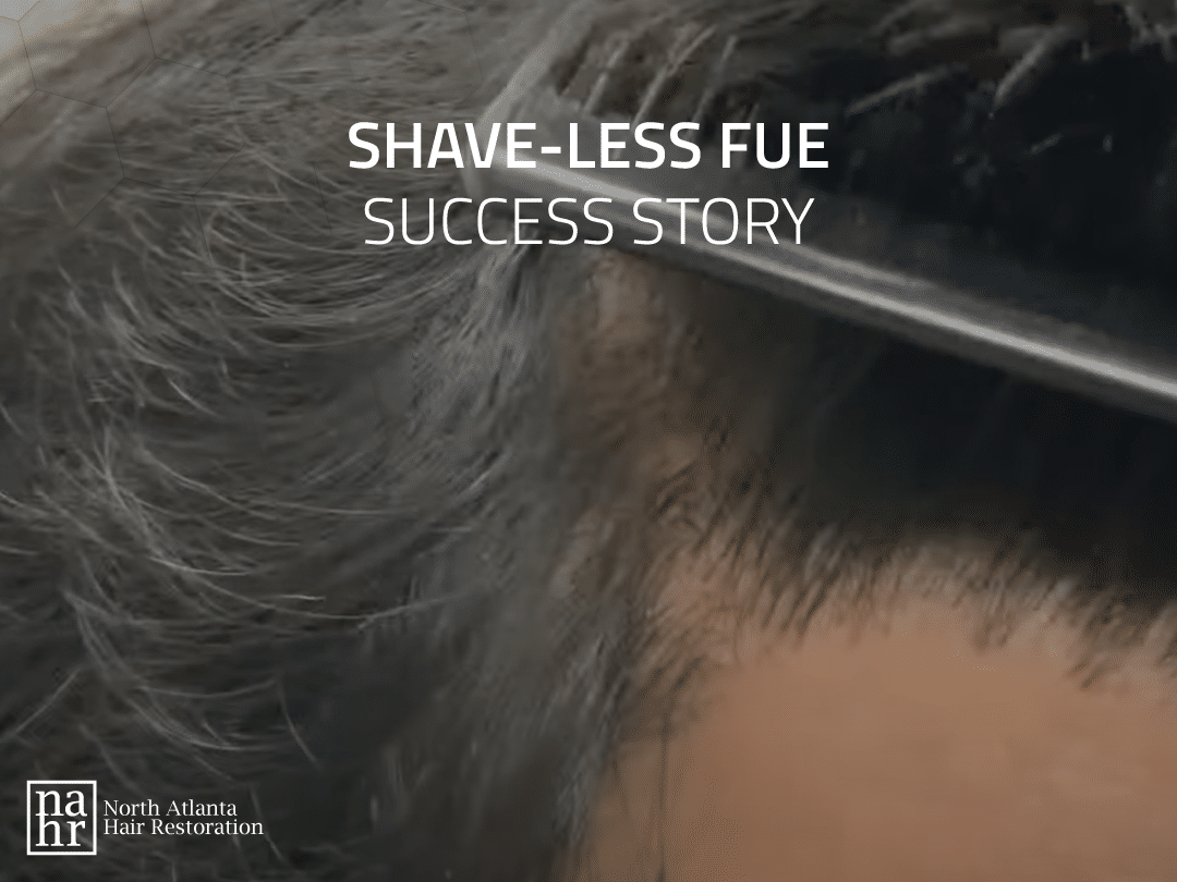 Video-Thumbnail-Shave-Less-FUE-Success-Story