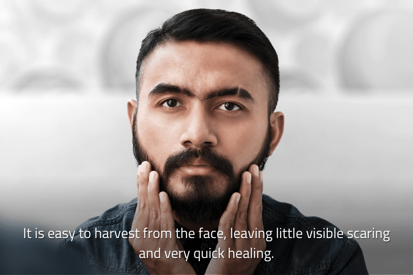 The greatest thing about a beard to head hair transplant is that it makes hair restoration possible for those who don't have enough head hair left for a transplant.