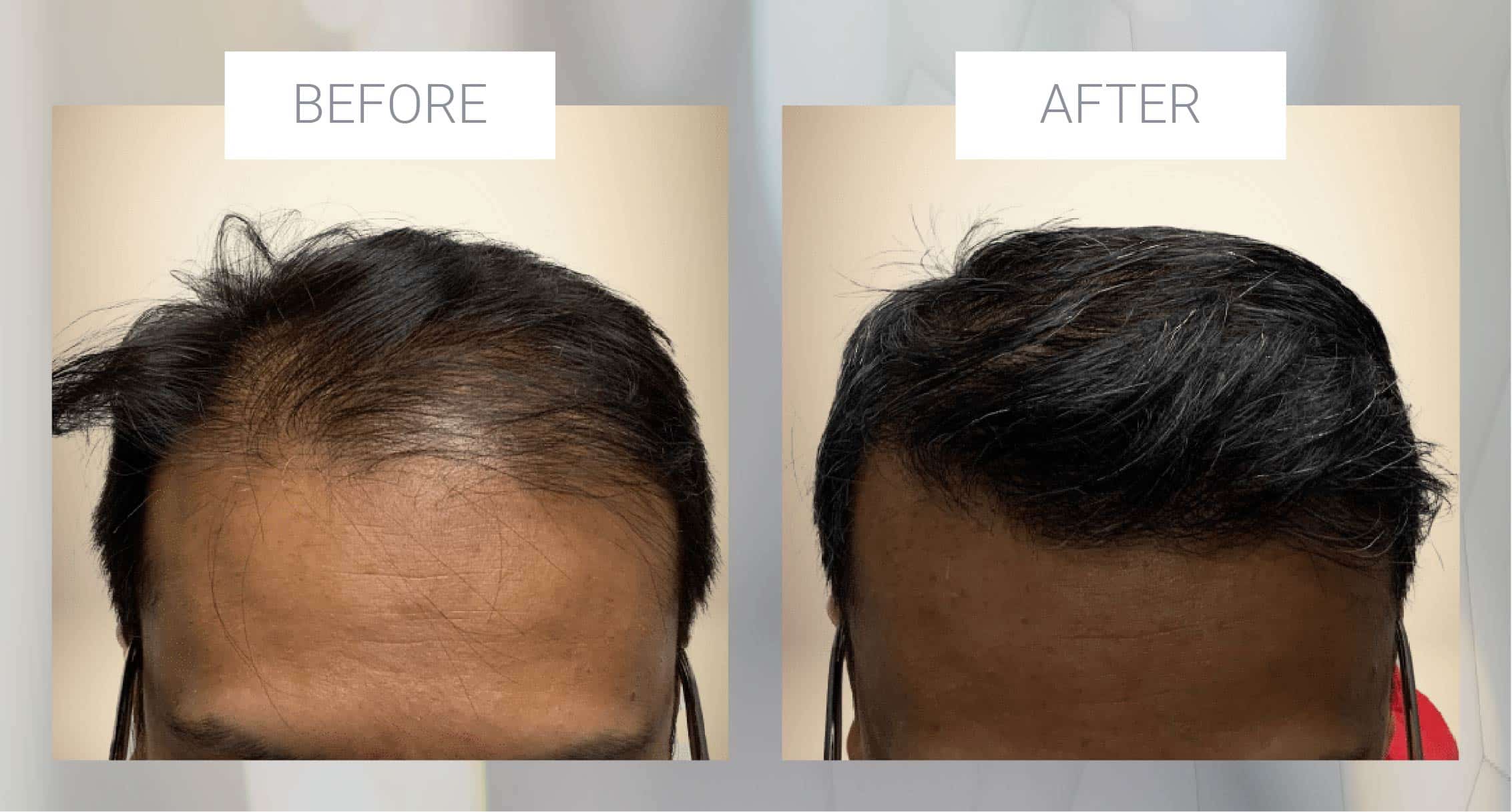 hair transplant before and after example