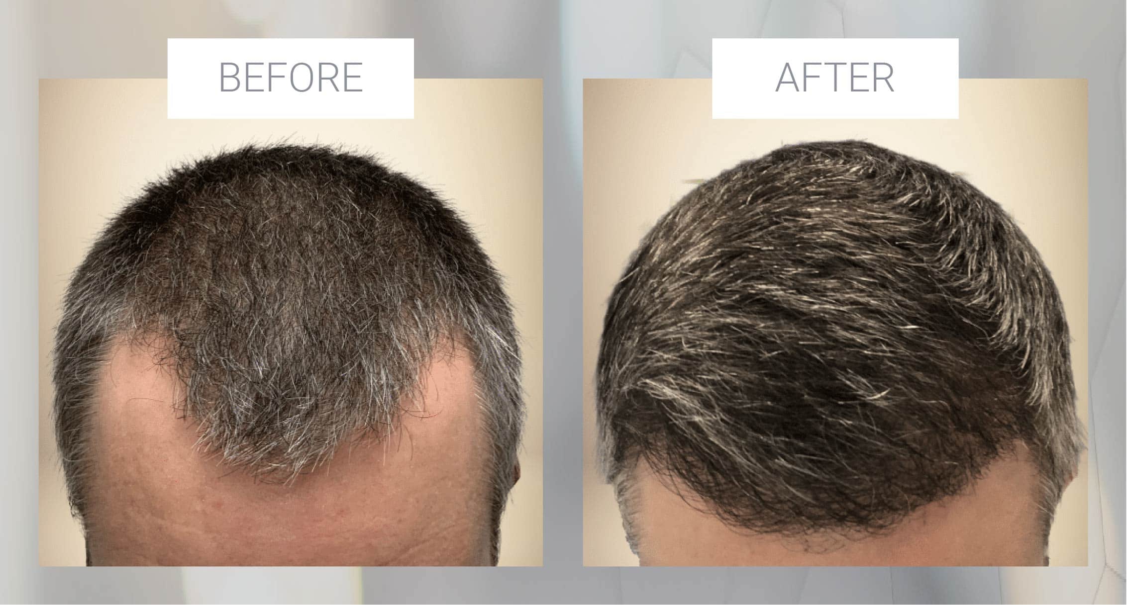hair restoration before and after example