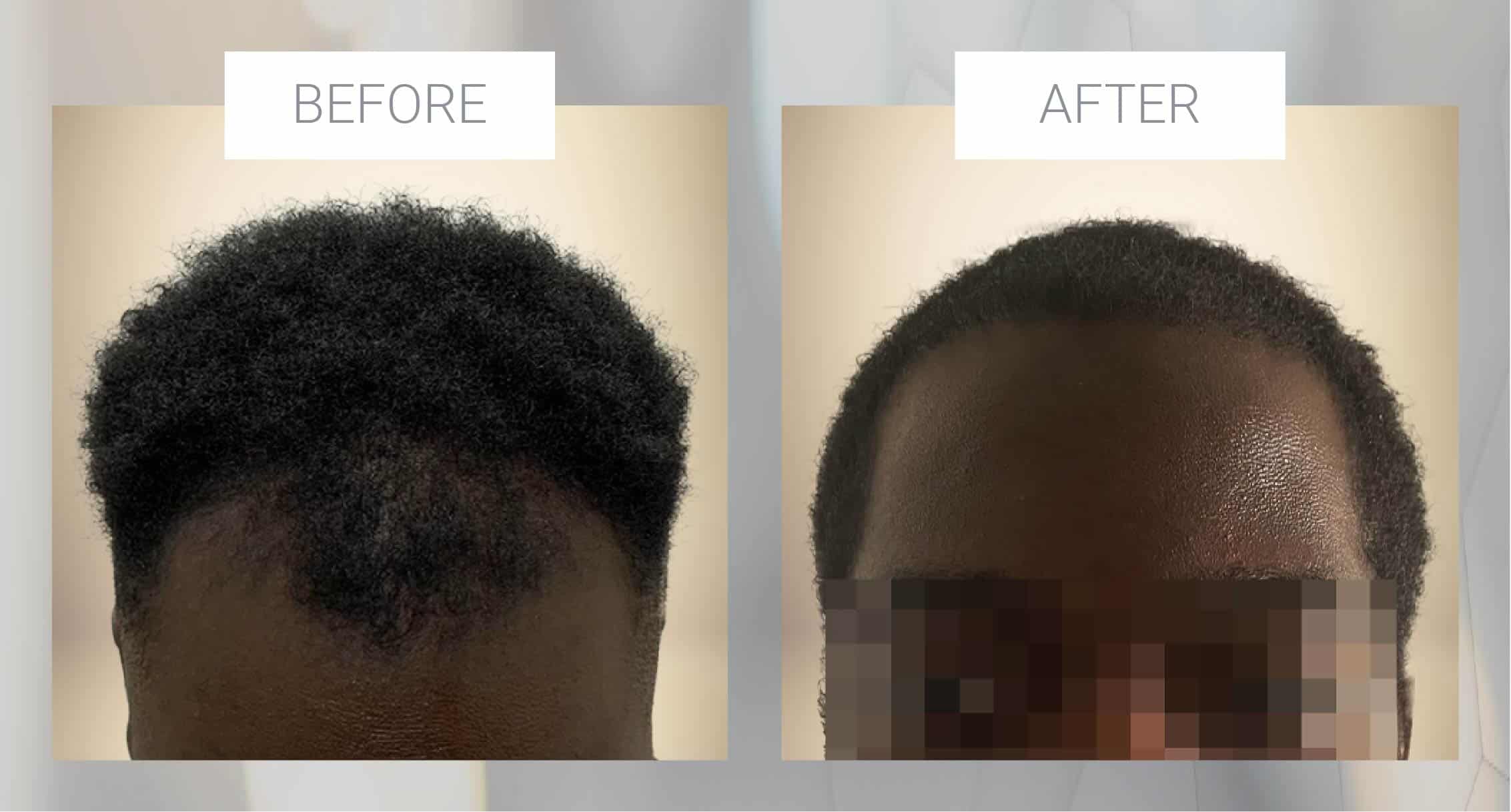 African Amercian Hair Restoration Before and After
