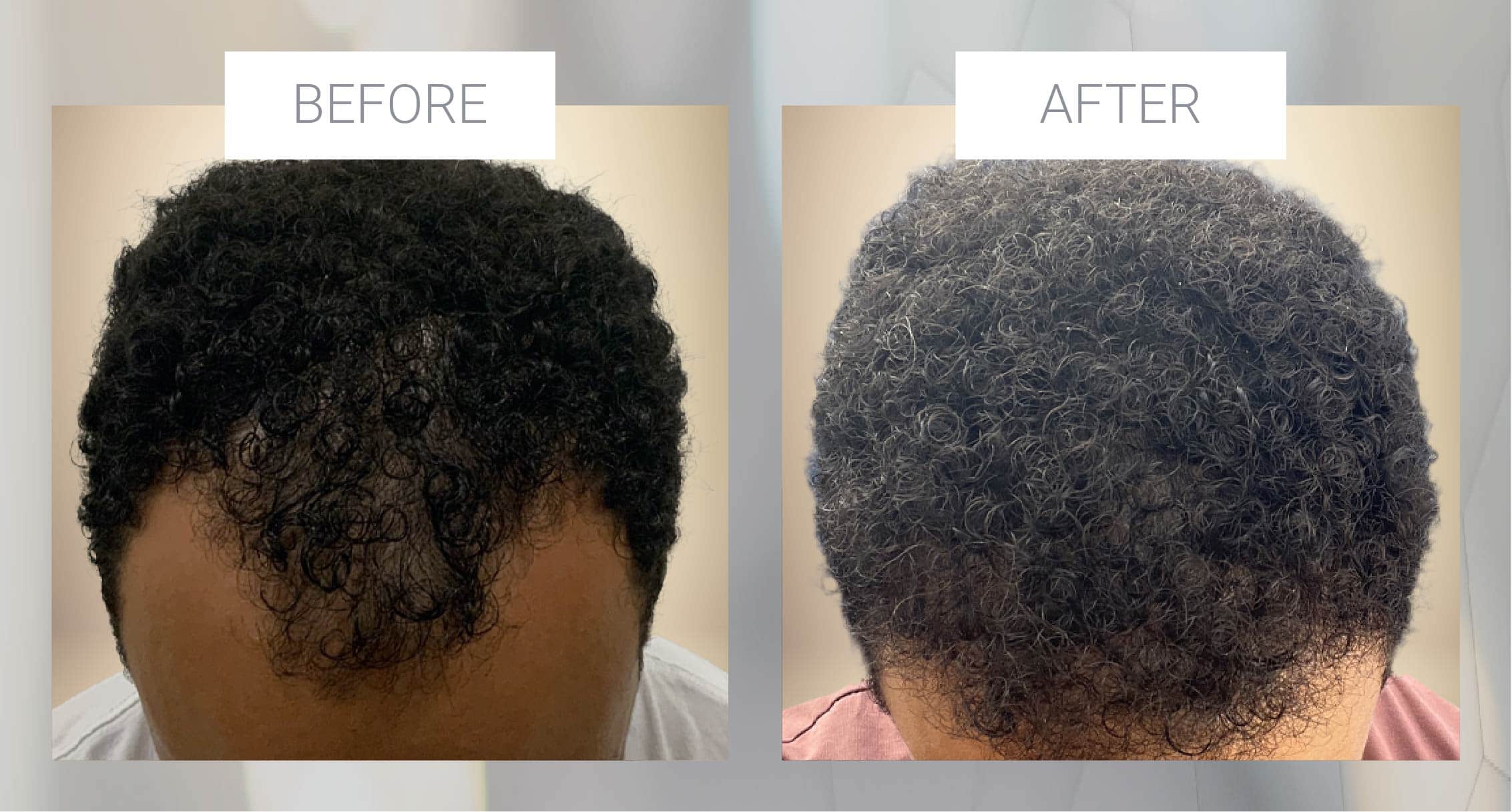 African American hair transplant example