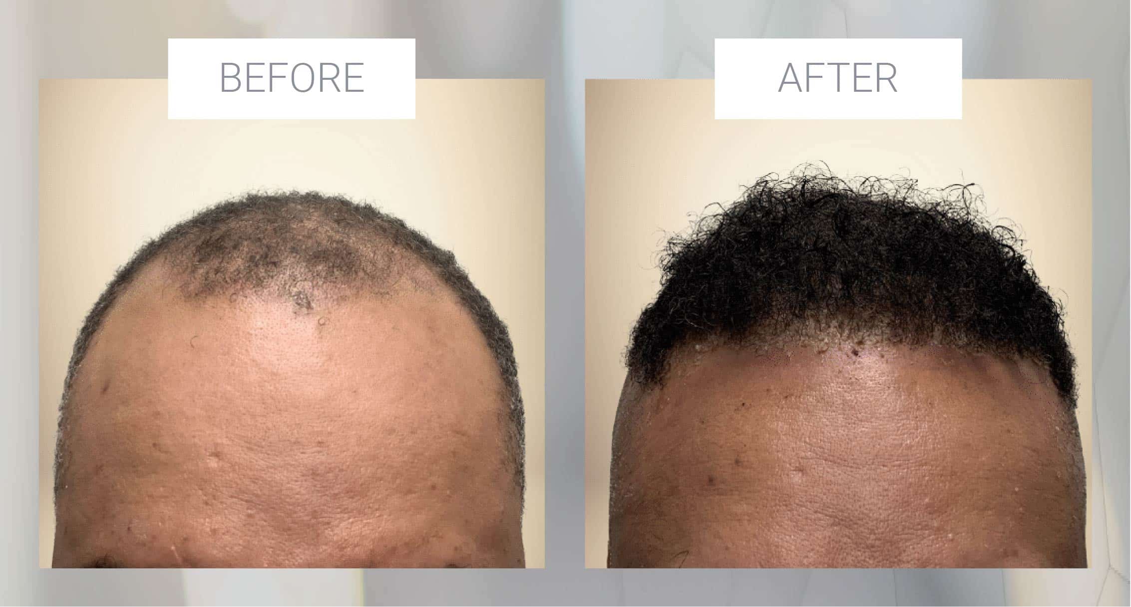 black hair restoration example