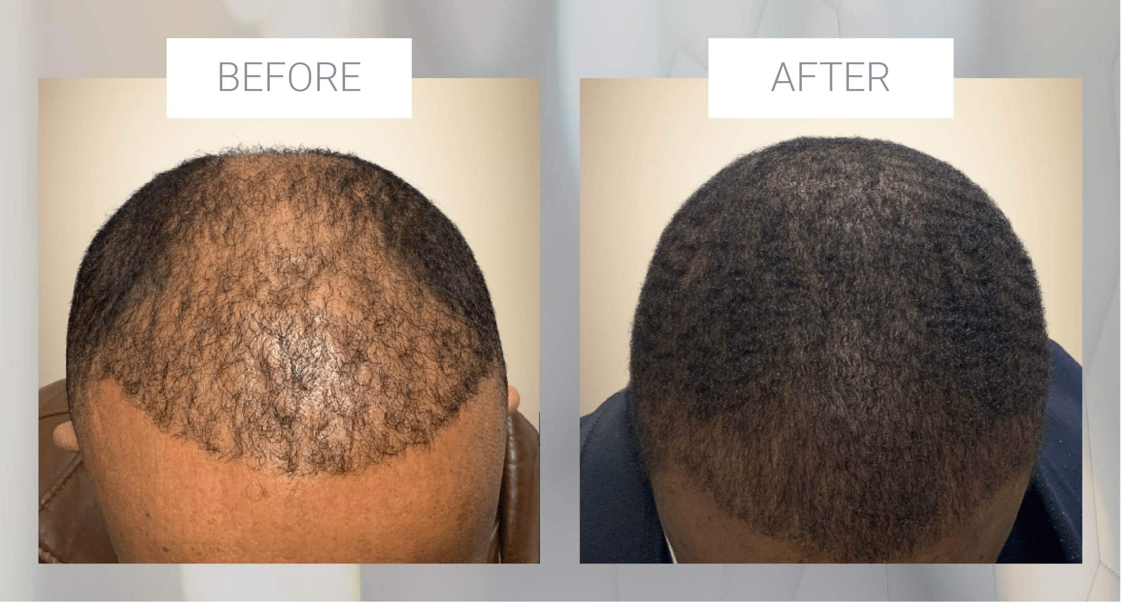 What African Americans Need to Know About Hair Transplants