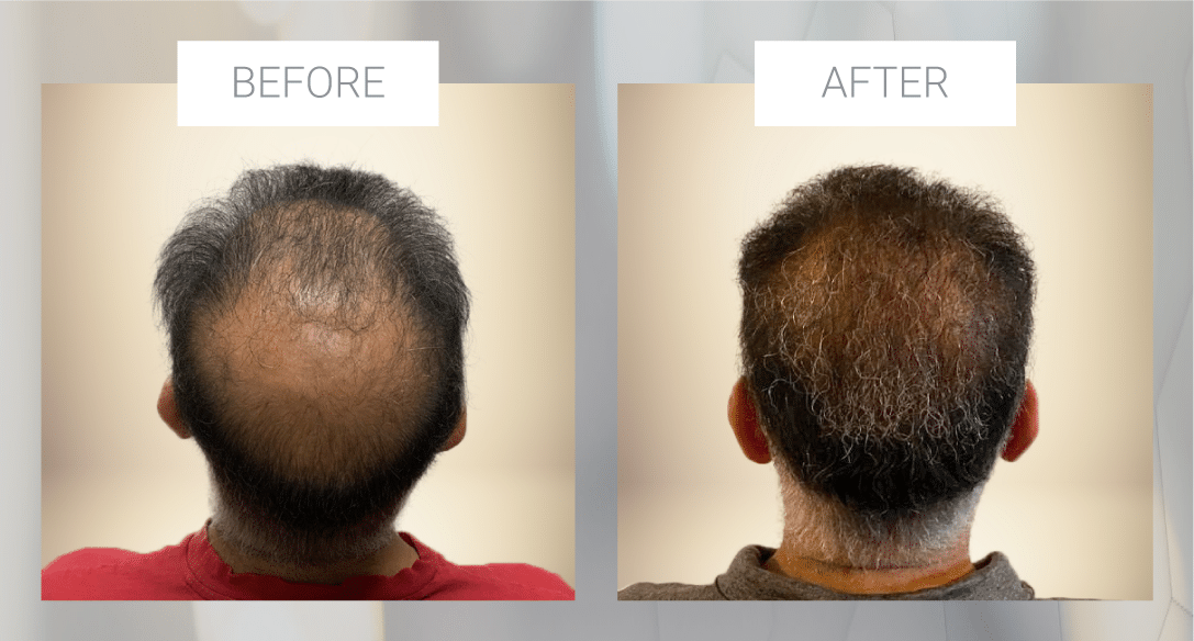 before and after of a shaveless fue procedure