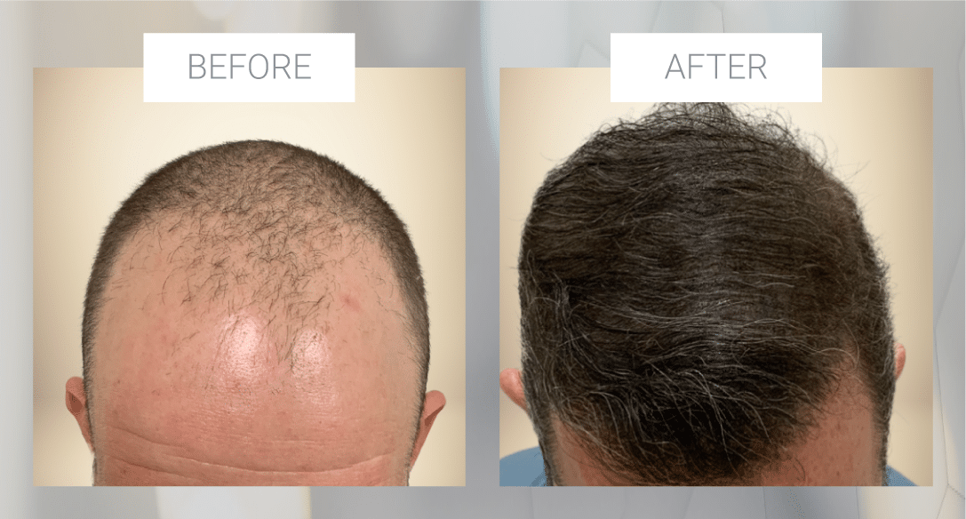 shave-less fue before and after