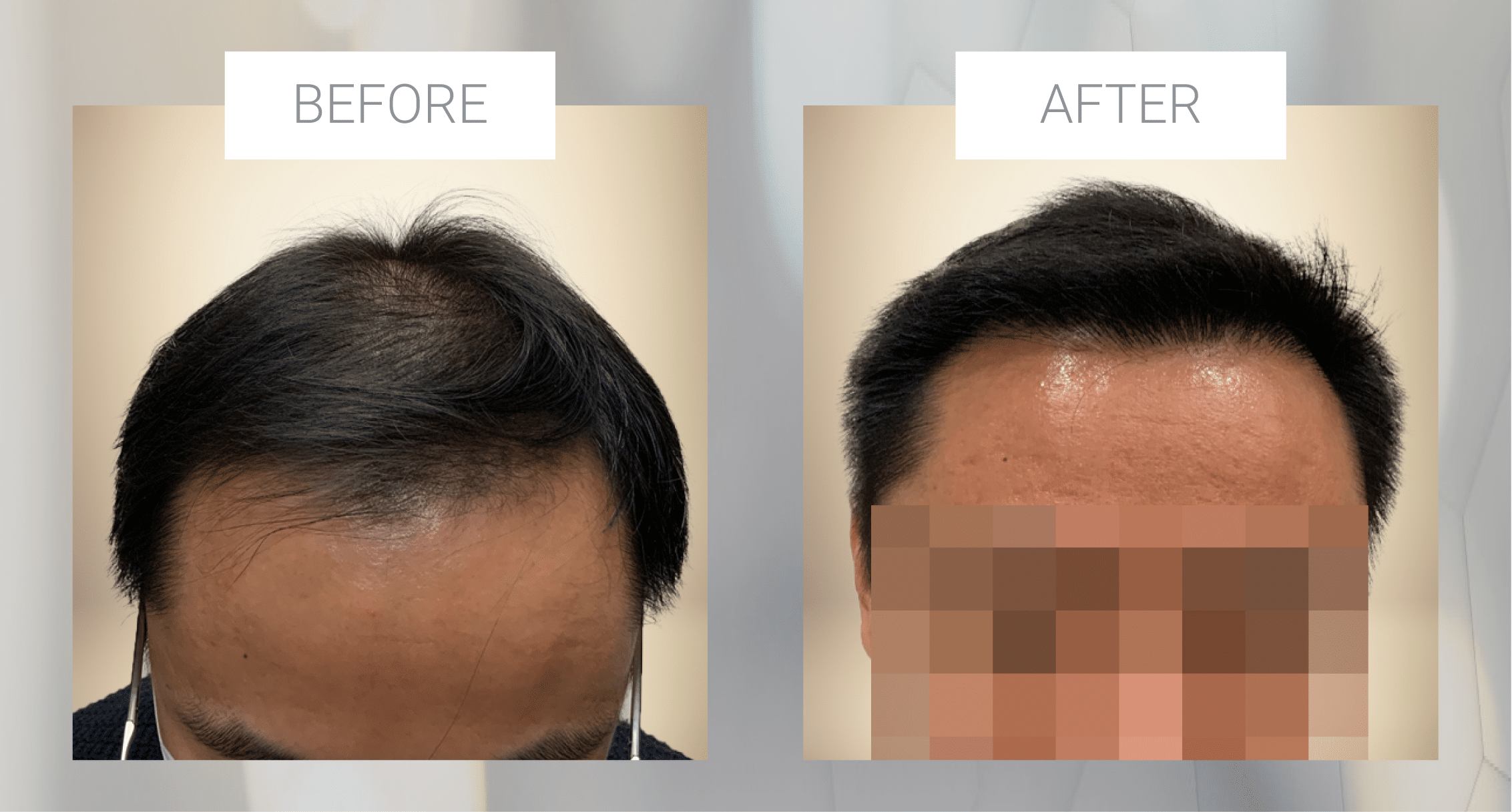 Example of hair restoration before and after