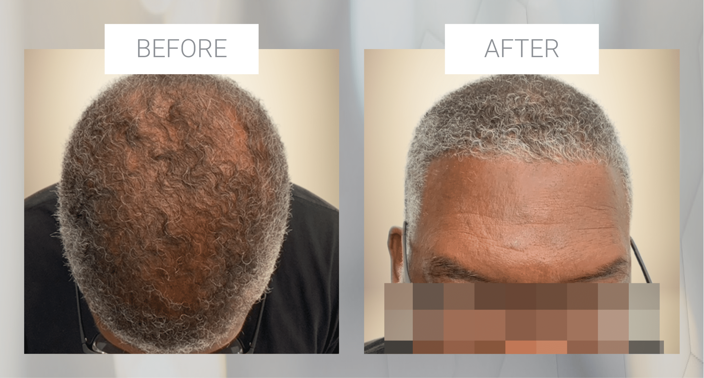 Hair Restoration Before and After