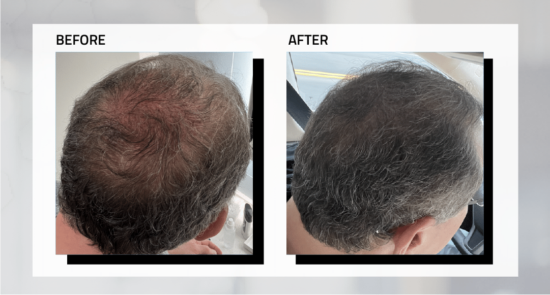 long-hair-transplant-before-and-after-photos-1
