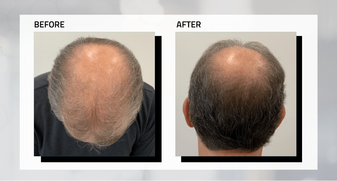 long-hair-transplant-before-and-after-photos-2