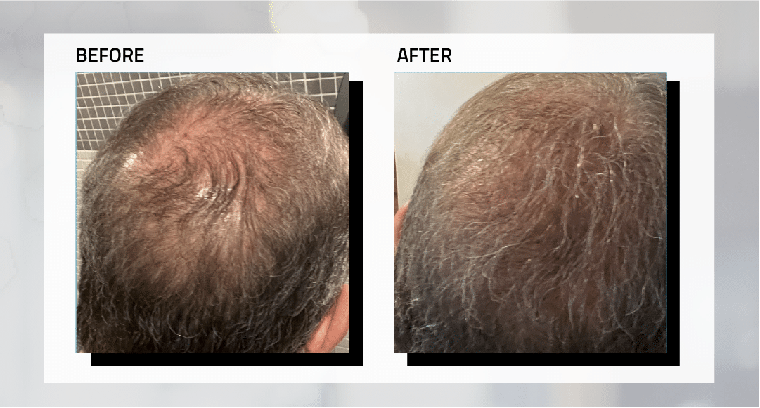 long-hair-transplant-before-and-after-photos-3